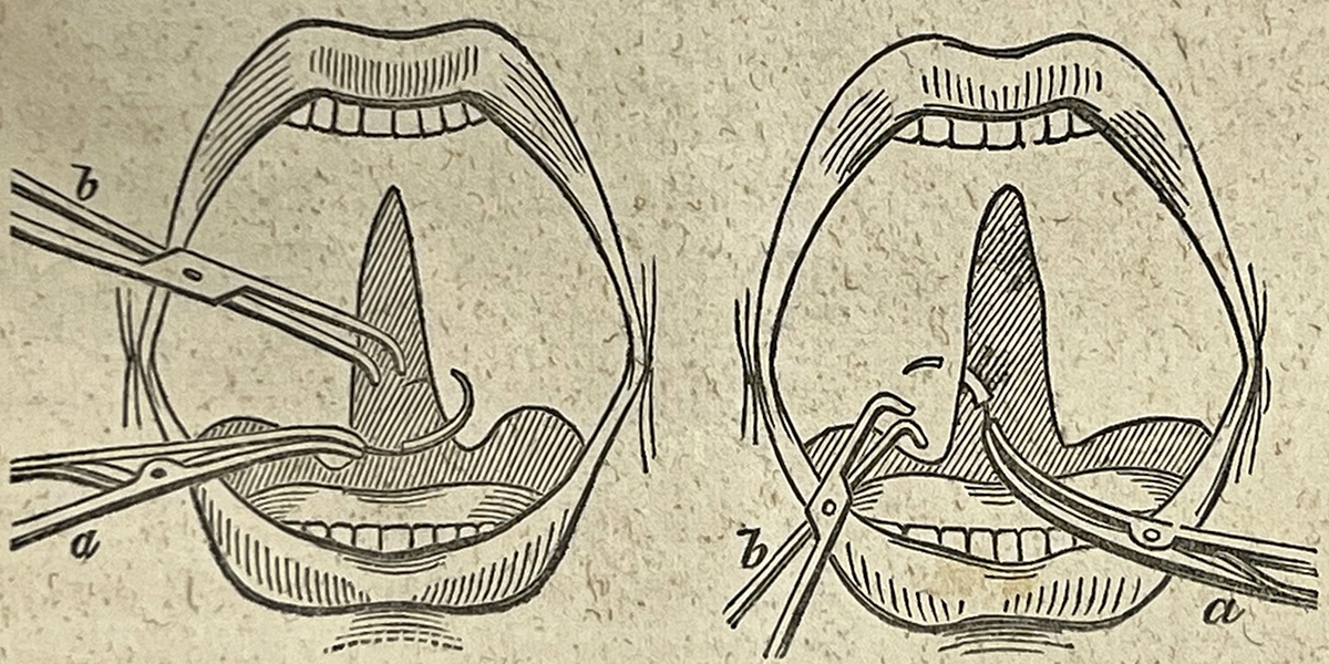 cleft palate surgery, c1843 image